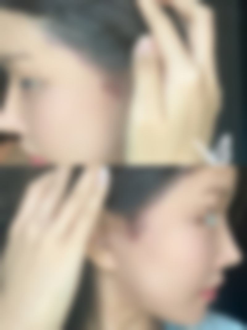 拉皮除皱成效怎么样多久见效