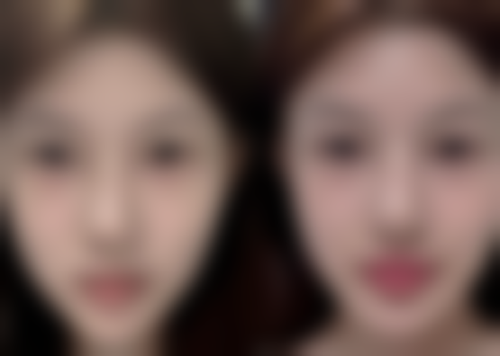 拉皮除皱是怎么做的