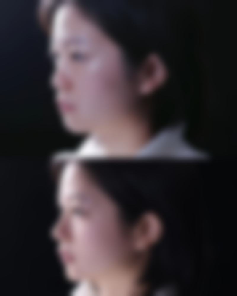 除皱针可以经常打吗