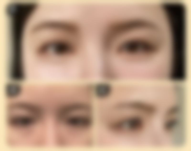 除皱针的危害和副作用