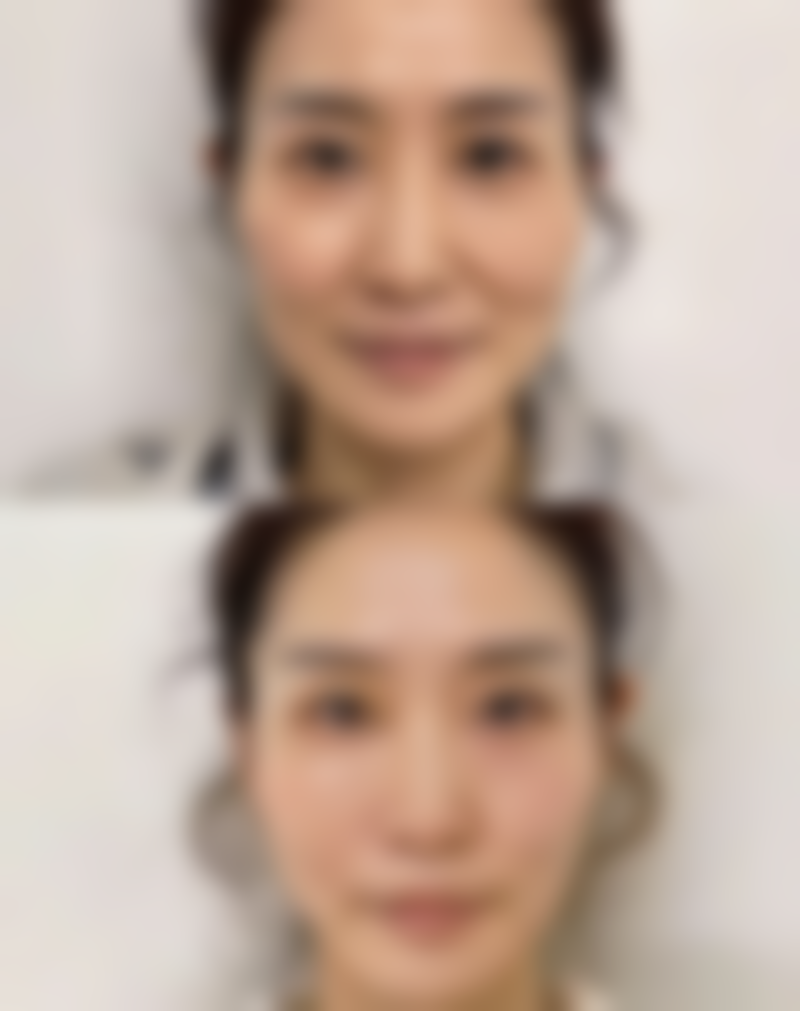 四、脸部打胶原蛋白的危害