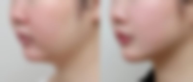 在哪打除皱针比较好？揭秘3大正规渠道，让你安全变美，轻松告别皱纹烦恼！ 