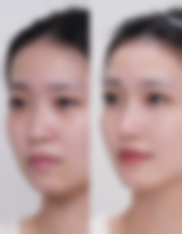 毛发种植有什么副作用