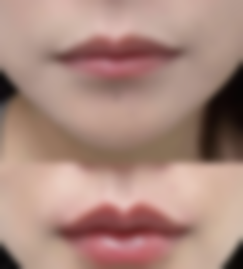 毛发种植技术好吗