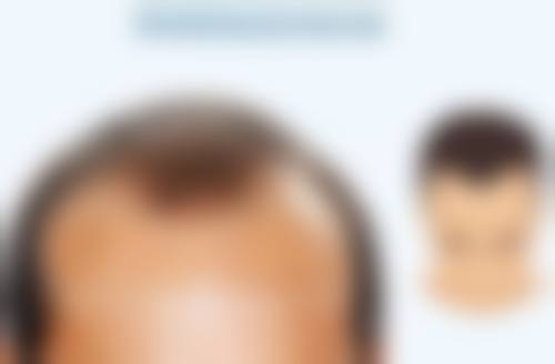 美白针多少钱一针