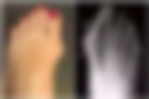 打完瘦脸针8天了感觉脸还是肿的