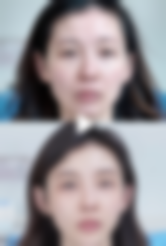 打完瘦脸针没效果怎么回事？揭秘3大常见原因，掌握4个补救方法让你轻松拥有小V脸！ 