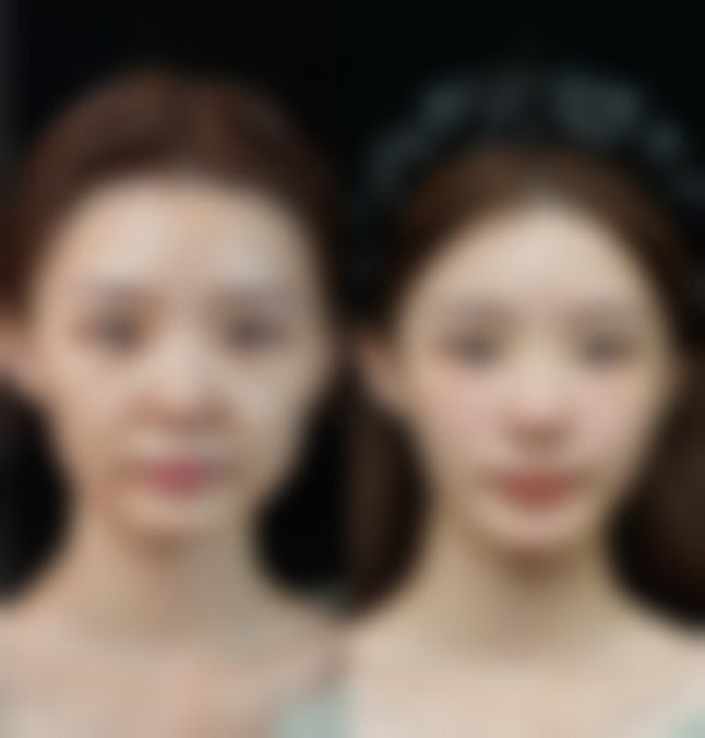 第一次打瘦脸针要打几针