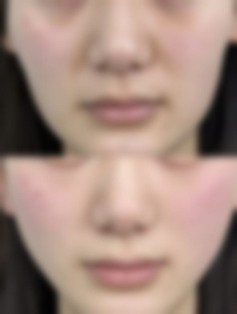 如何延长瘦脸针成效