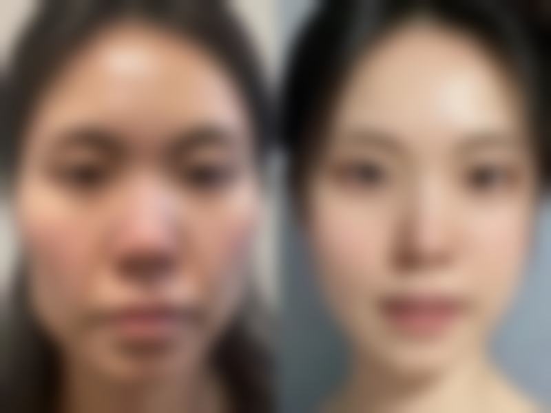 瘦脸针下巴一起打脸会变小吗