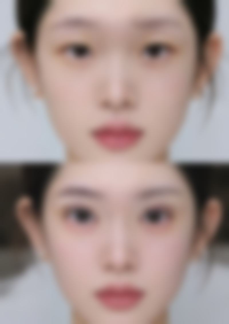 瘦脸针打咬肌的副作用