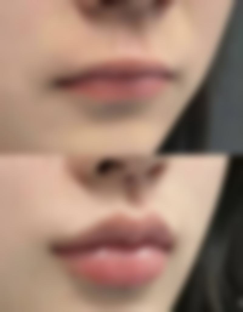 瘦脸针多少钱打一针