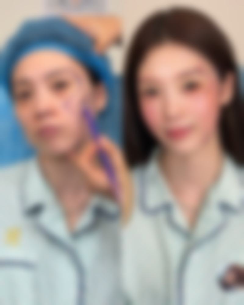 瘦脸针打下巴前后对比照片