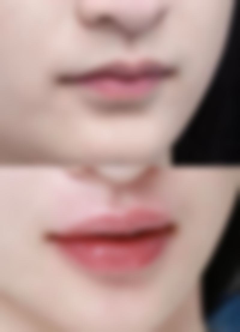 环切包皮手术会切到系带吗