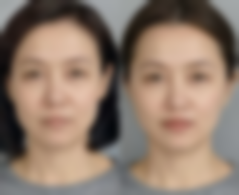 打瘦脸针咬肌鼓出一个包是怎么回事