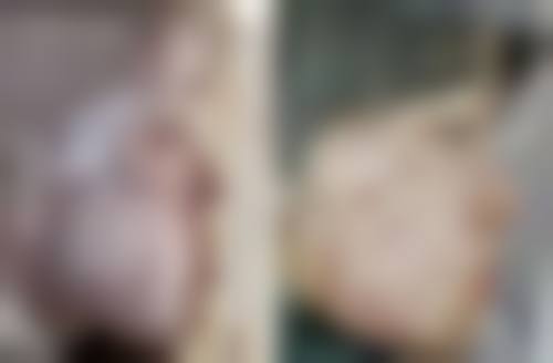 瘦脸针会反弹么