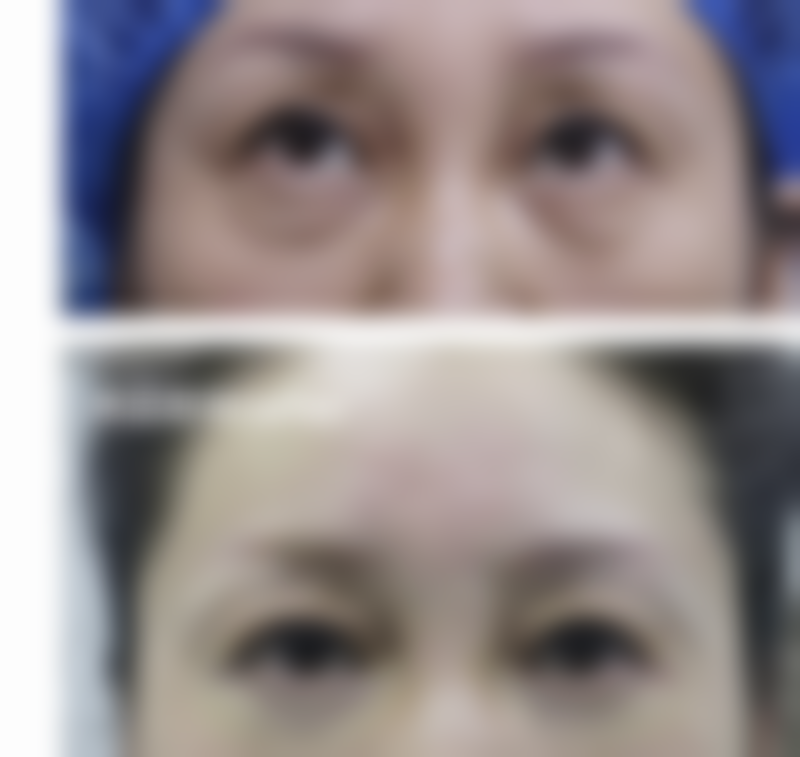 毛发种植效果好不好啊？揭秘毛发种植90%高成活率的秘诀，让你轻松拥有浓密秀发！ 