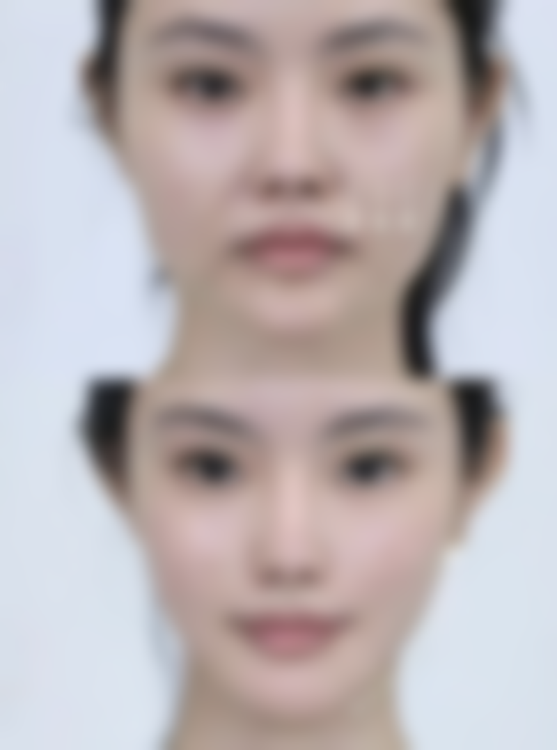 毛发种植成功几率高吗