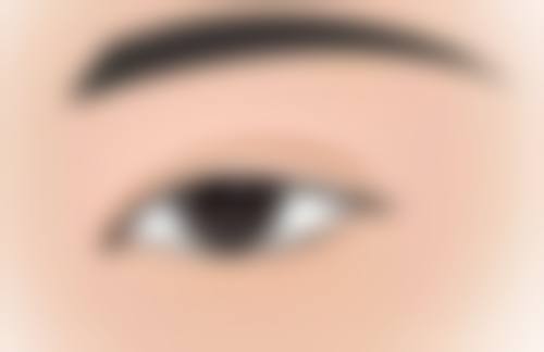 下巴后缩的矫正过程