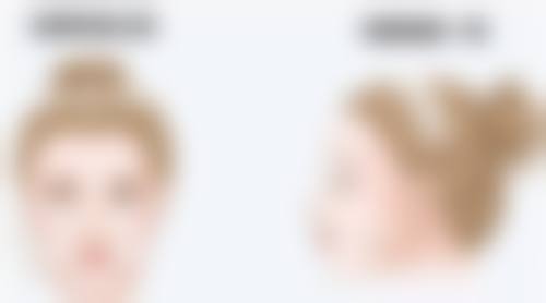 下巴后缩怎么正畸