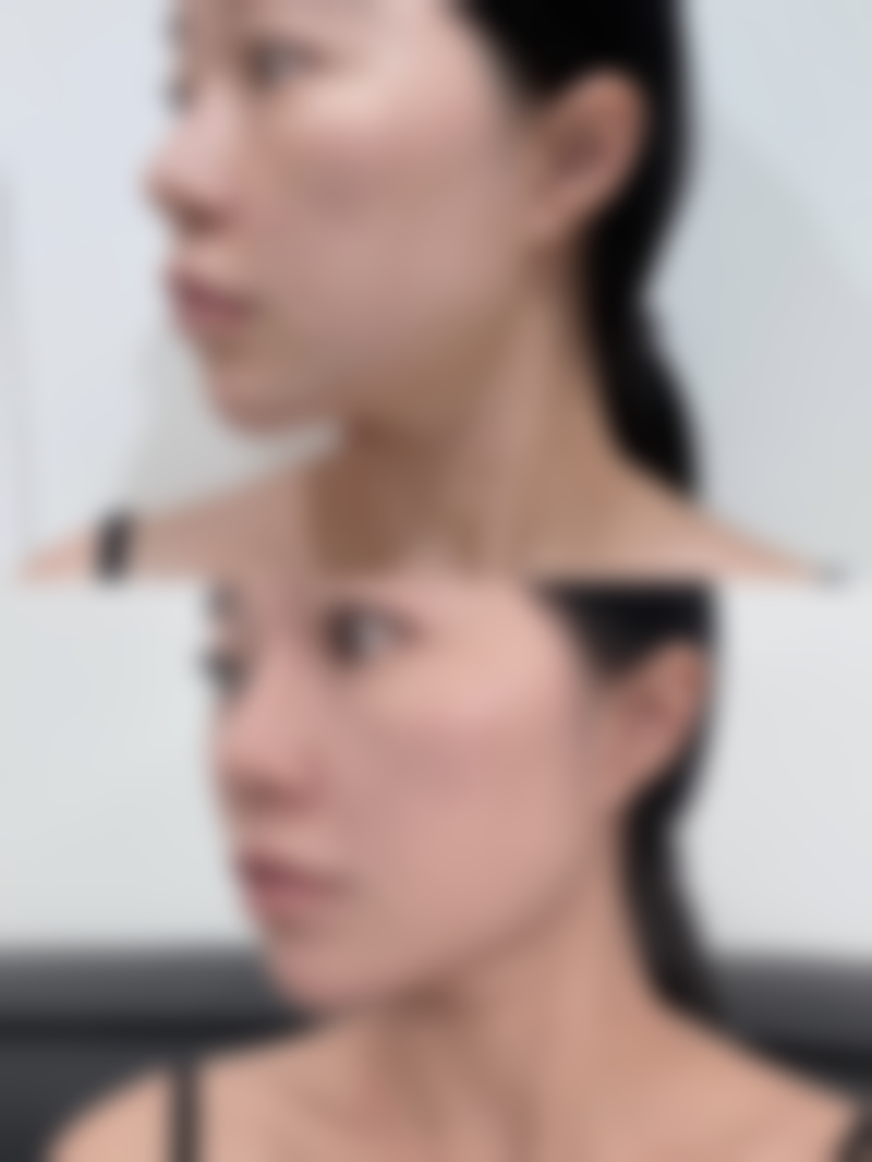 成人下巴后缩如何矫正