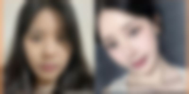 毛发种植后多久开始掉?