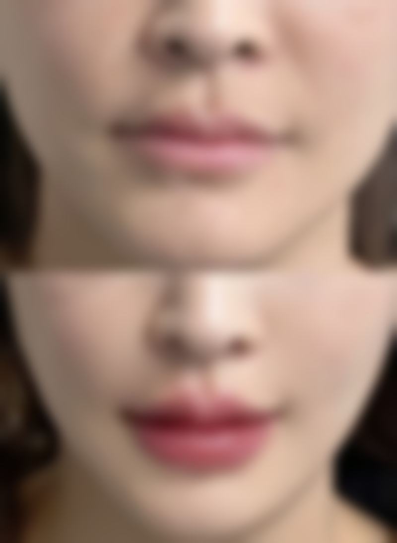 毛发种植后一般多久可以长出？了解3大阶段生长时间，让你清晰掌握毛发新生节奏，重拾浓密秀发不是梦！ 