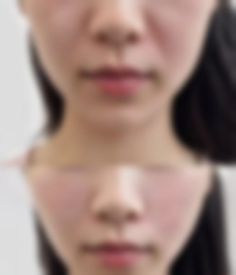 骨性下巴后缩如何矫正