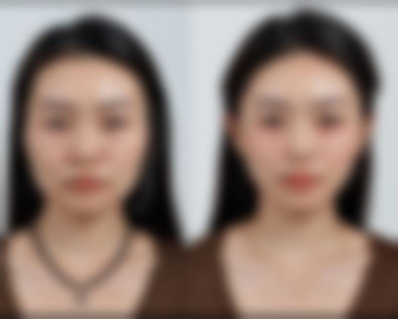 下巴后缩如何矫正视频