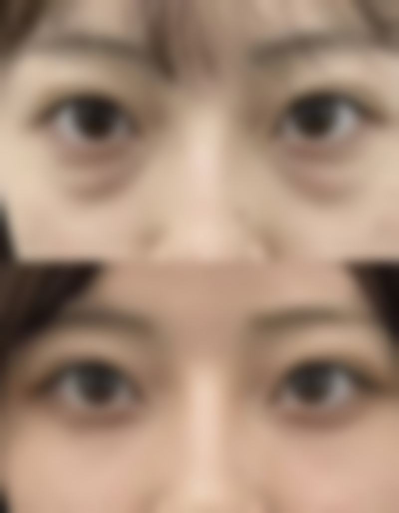 美白针多久一次至佳