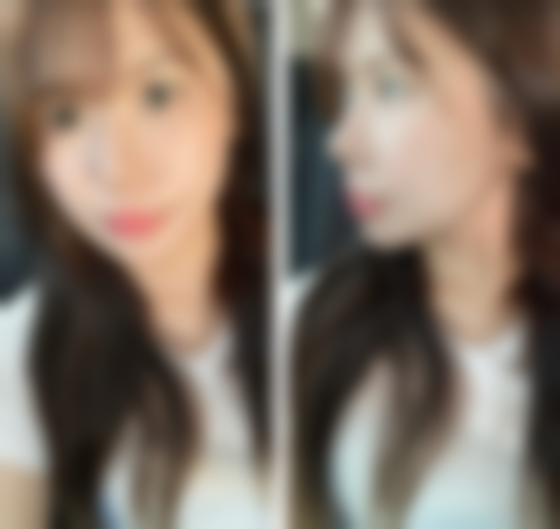 瘦脸针的注射频率