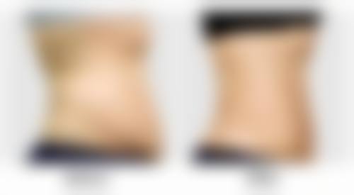 嘴唇疤痕增生怎么修复?