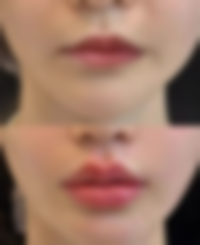 不整容让嘴唇变薄的方法