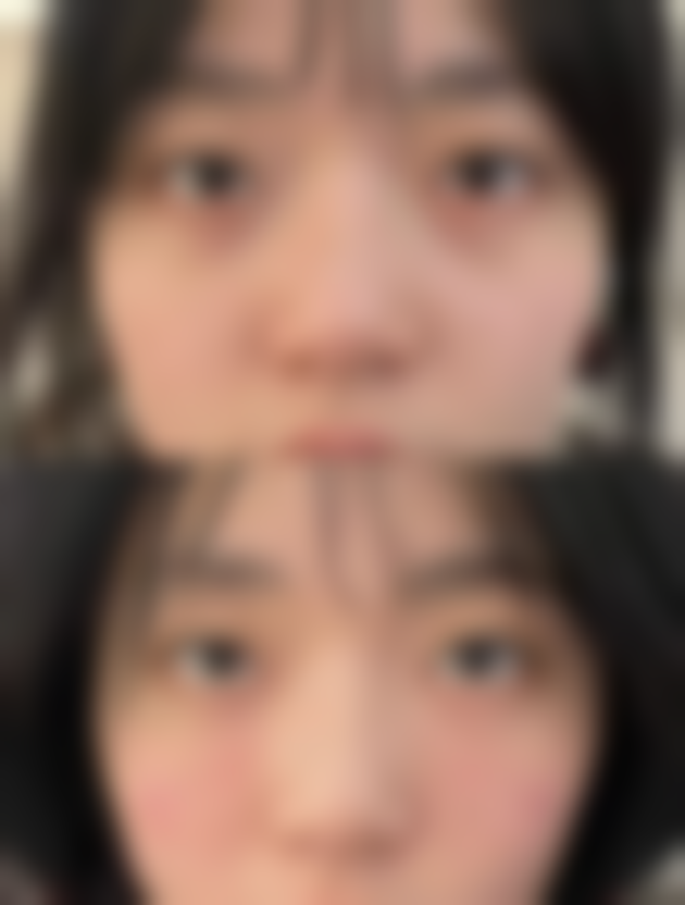 打瘦脸针脸会瘦吗