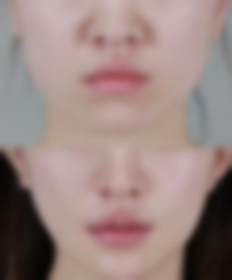 不同成因的厚唇解决办法