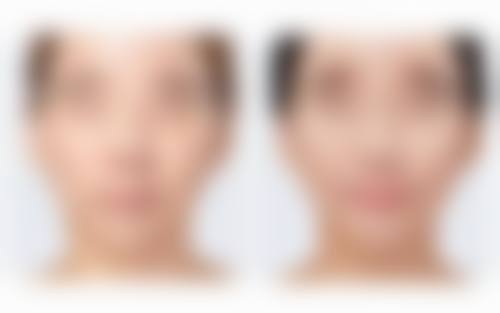 打完瘦脸针8天了感觉脸还是肿的