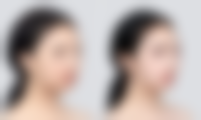 打瘦脸针有没有害？权威解析：正确操作下瘦脸针不仅无害，还能让你30天拥有精致小V脸！ 