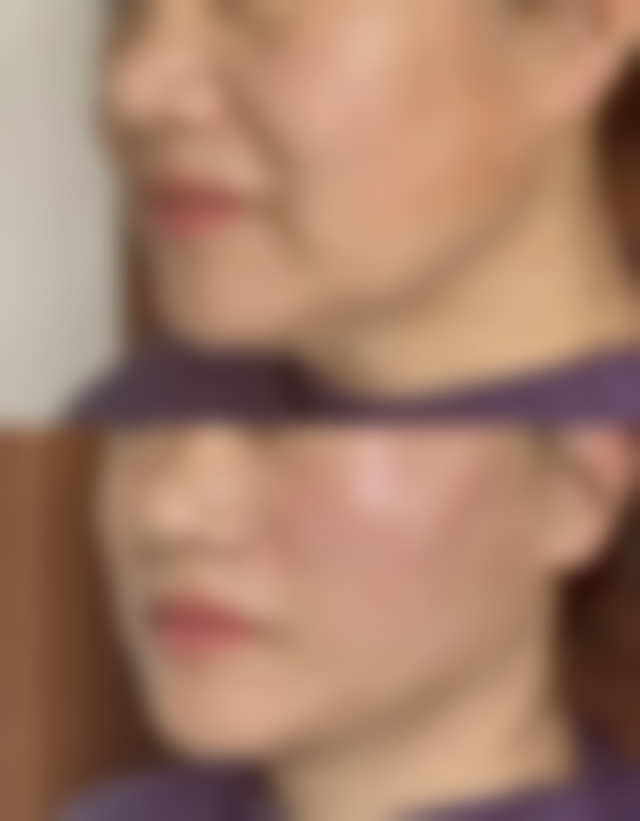 瘦脸针打一次维持多久