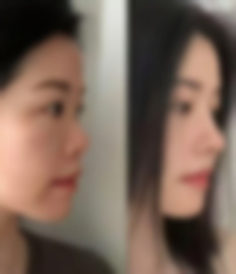 瘦脸针注射的注意事项