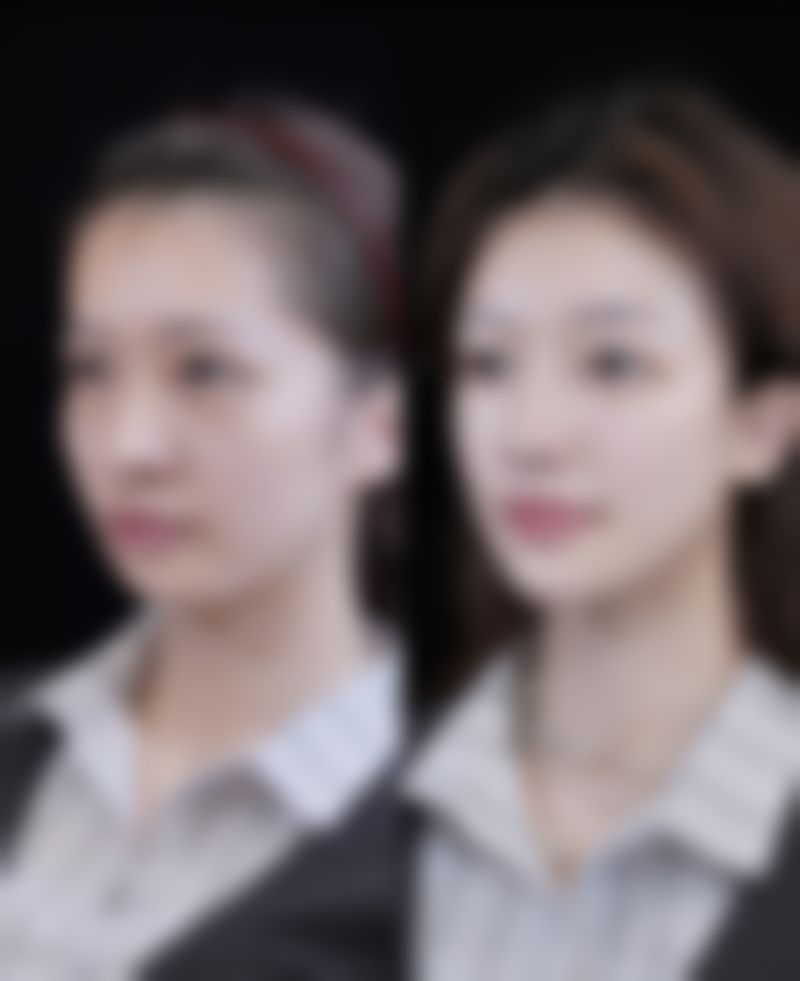 注射除皱针后的护理