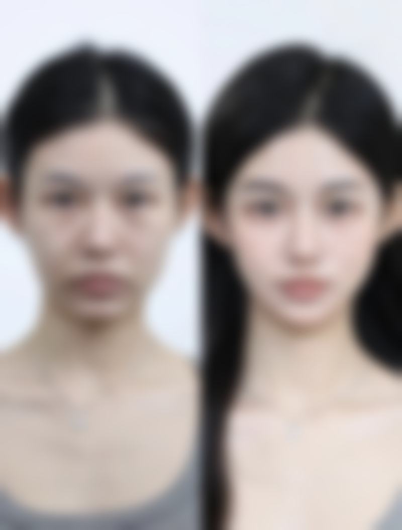 注射除皱针会老得更快吗