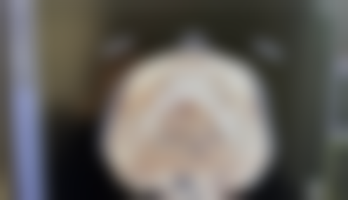 瘦脸针50单位相关问题