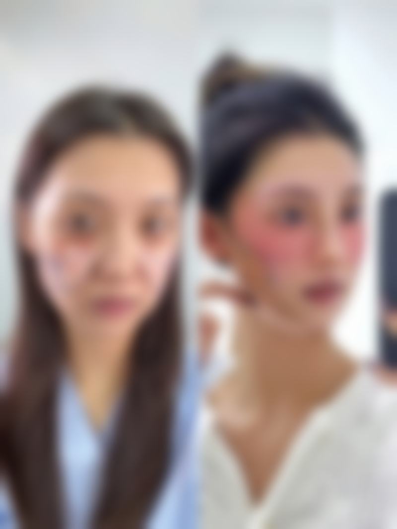 嘴巴一大一小怎么矫正？揭秘3种常见医美矫正方法，让你轻松拥有对称美唇！ 