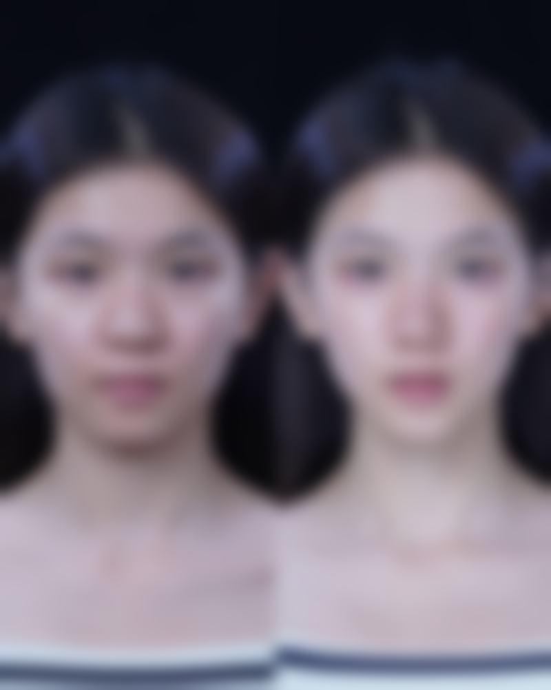 打了瘦脸针需要注意什么事项