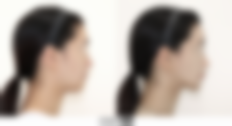 打了瘦肩针多久能看到成效