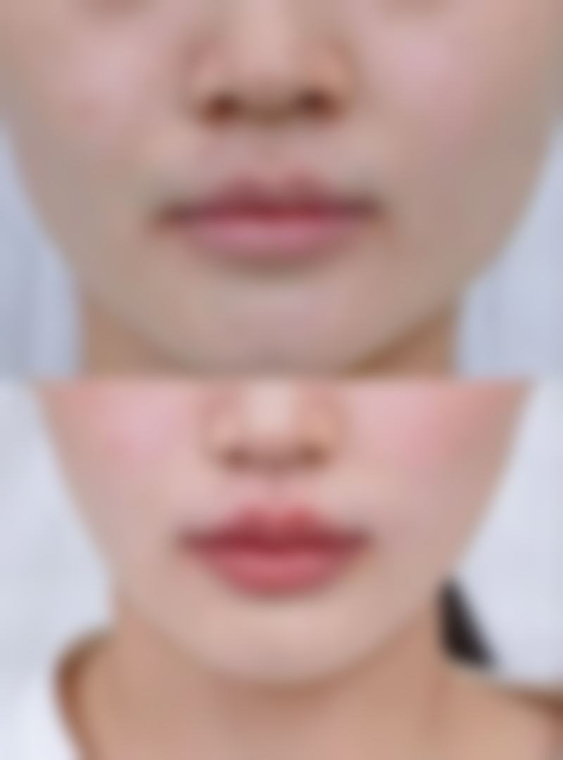 嘴巴一边大一边小该怎么矫正