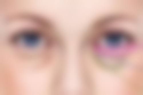 丰太阳穴一般需要多少支玻尿酸？权威揭秘不同情况用量，让你轻松掌握变美“剂量密码”！ 