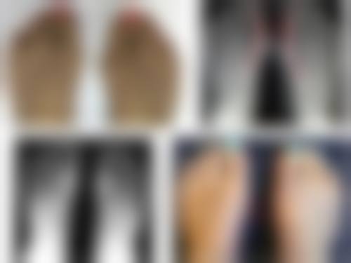 瘦脸针价格及适用人群