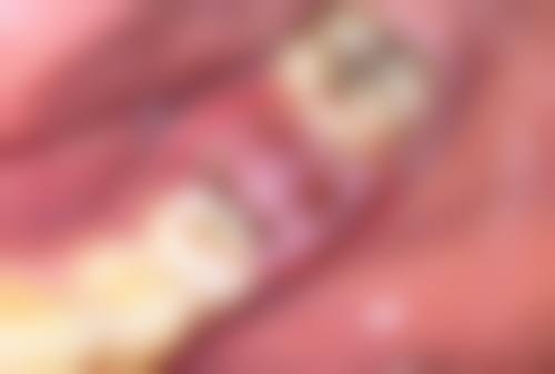 玻尿酸丰太阳一般多少钱一支