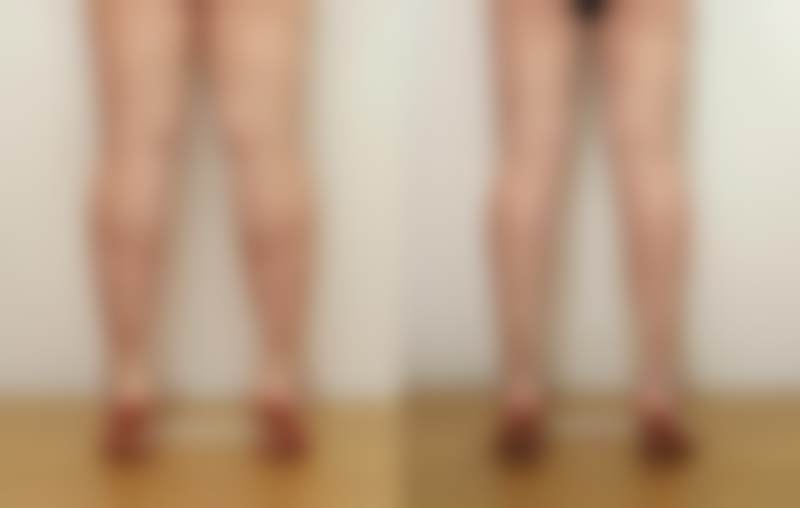 韩国sage医院李敬秀医生价目表2026中的瘦小腿项目适合我吗？